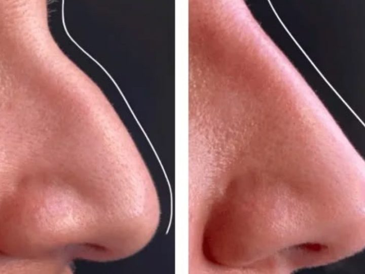 Can Rhinoplasty Correct Birth Defects?