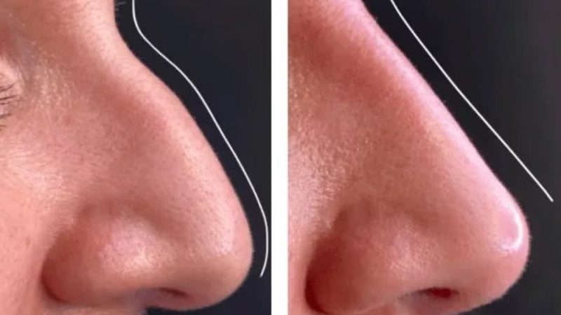 Can Rhinoplasty Correct Birth Defects?