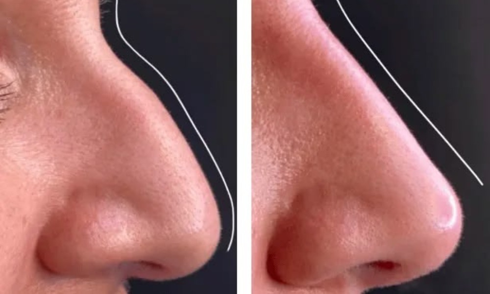 Can Rhinoplasty Correct Birth Defects?